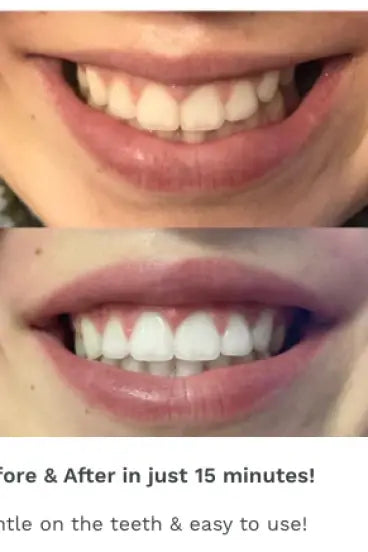 Dual-light Therapy Teeth Whitening System by beaut. - Melissa Jean Boutique