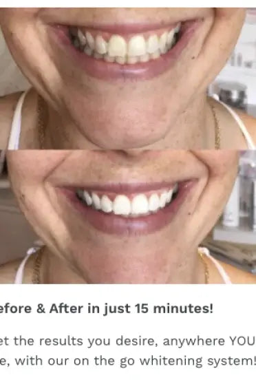 Dual-light Therapy Teeth Whitening System by beaut. - Melissa Jean Boutique