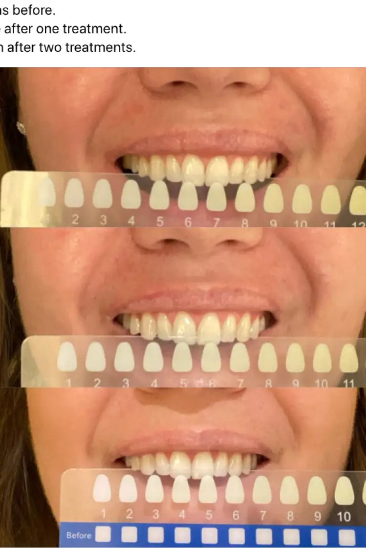 Dual-light Therapy Teeth Whitening System by beaut. - health &amp; beauty