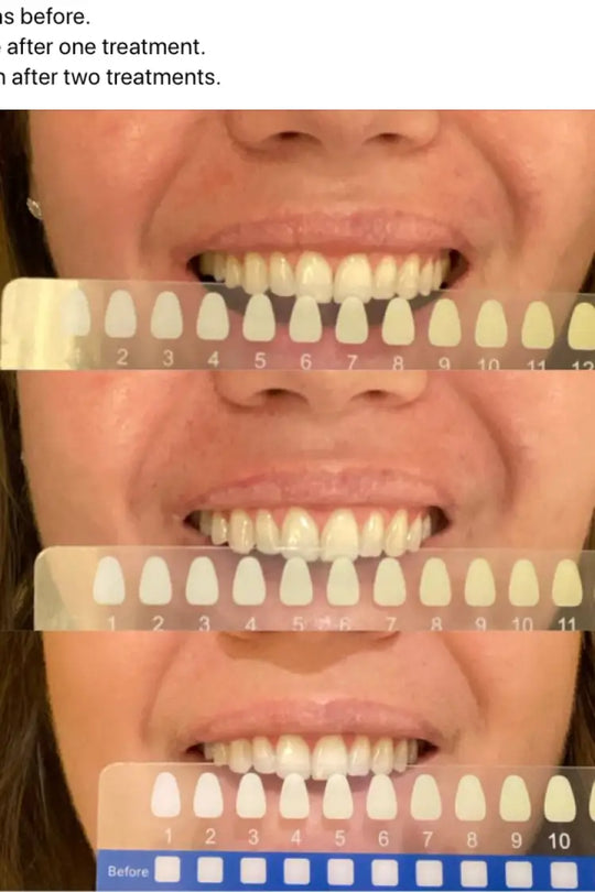 Dual-light Therapy Teeth Whitening System by beaut. - health &amp; beauty