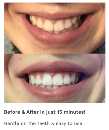 Dual-light Therapy Teeth Whitening System by beaut. - Melissa Jean Boutique