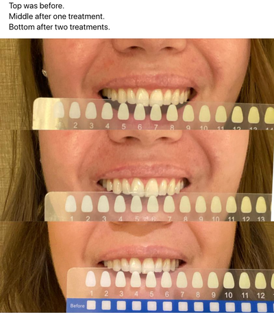 Dual-light Therapy Teeth Whitening System by beaut.
